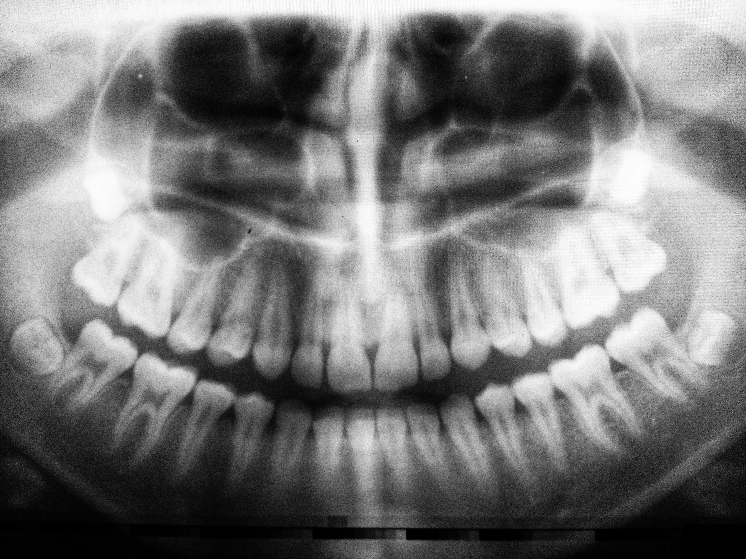 xray of teeth